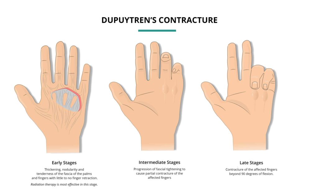 A graphic for Dupuytren's Contracture showing how the fingers on and nodules within the hand look in the progression of the disease: early, intermediate and late stages.